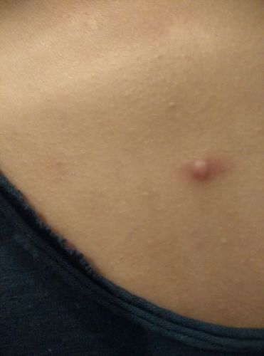 我的胸前长了一颗痘痘