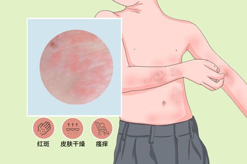 性皮炎 是否常见: 是 是否遗传: 是 并发疾病: 传染性软疣,细菌感染