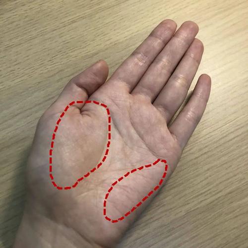 最后,刘潇聪医生嘱托已经确诊为肝硬化的患者也一定要积极治疗.