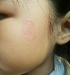 闺女脸上长个癣,懂的麻烦给看看. - 玩主论坛