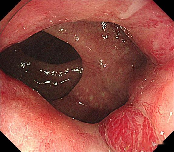 医学课堂|一例结直肠血管扩张症患者的诊断与分析