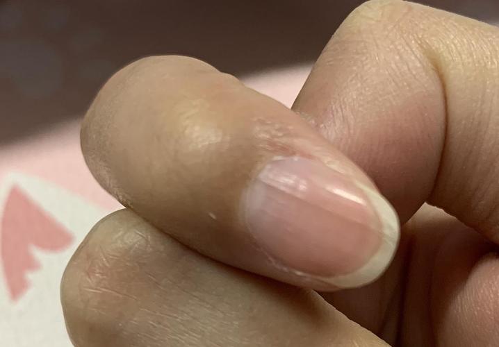 指甲上有一条黑线