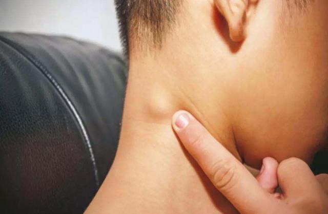 但淋巴结体积一般都不会超过1cm,淋巴结比较集中的部位,如腋下和颈部