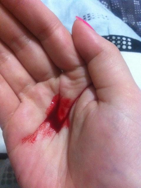 从小到大鼻子很少出血,从昨天到今天一天一次,只有右侧出,口里也是