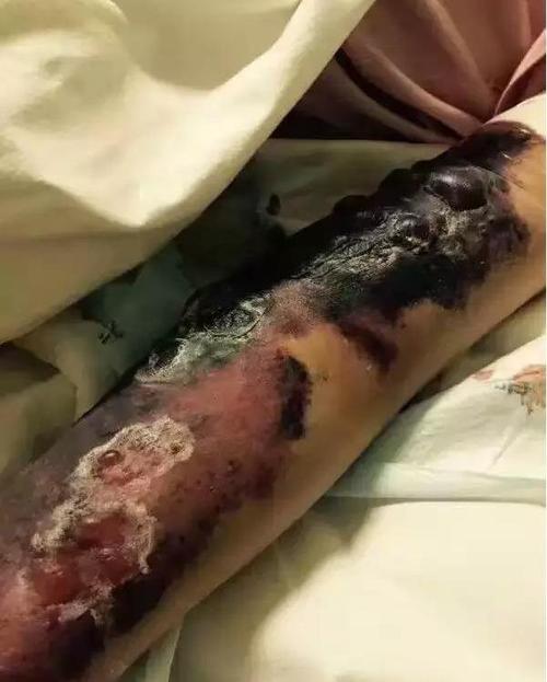 从徐婷之死看淋巴癌的可怕, 及中西医治疗的利弊!