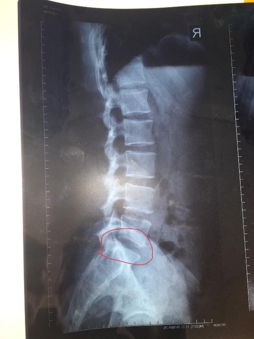 哪位懂骨骼,帮看看我腰椎有没有问题呗?