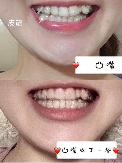 戴隐形牙套不到10个月侧貌改变真的是绝了