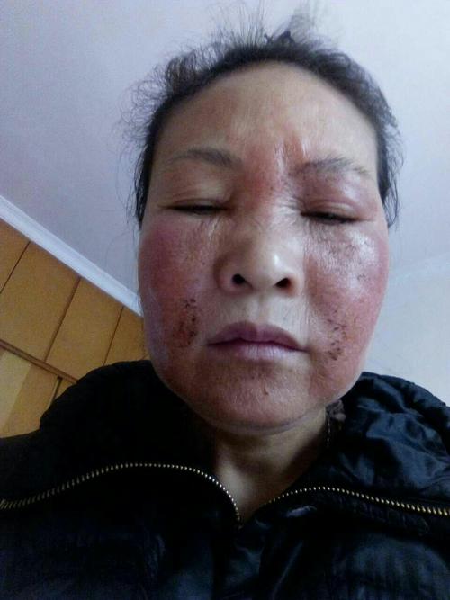 荨麻疹的病人做了排毒反应,一张一张漂亮,脱胎换骨,与