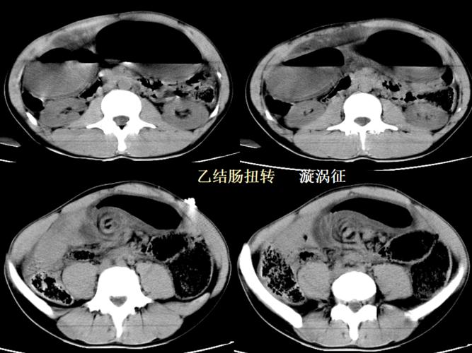 ct入门 | 肠梗阻的ct影像诊断