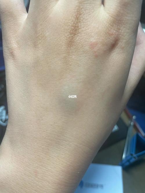 手背血管突然鼓了个包_静脉曲张_医疗健康_医疗健康