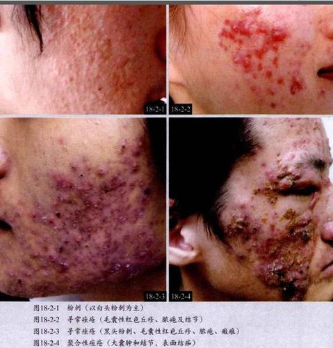 史上最全皮肤病图谱(附治疗方法)