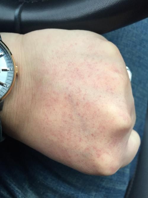 昨晚喝过白酒 今天早上起来突然发现手背长了好多红点