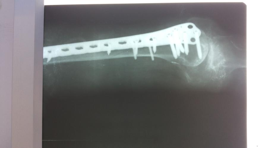 90岁股骨远端长螺旋形骨折