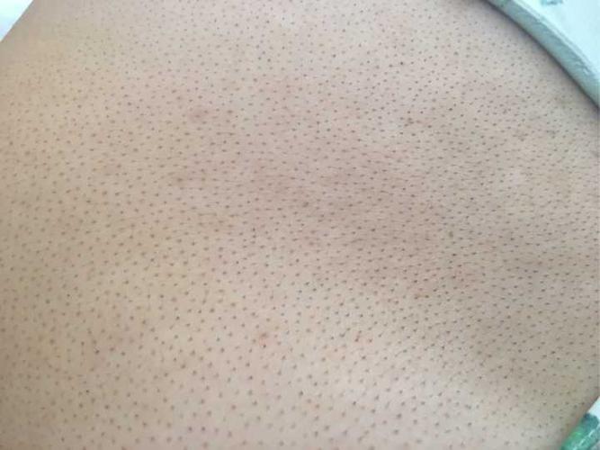 女生背上毛孔粗大怎么办?