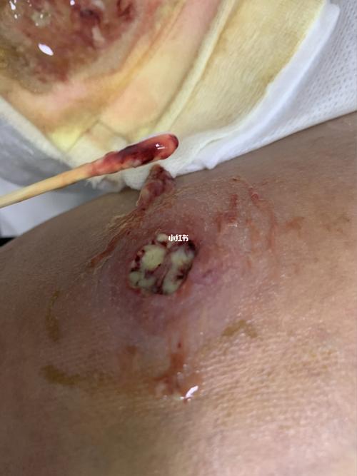 大疖子的后续_火疖子_医疗健康_医疗健康其他