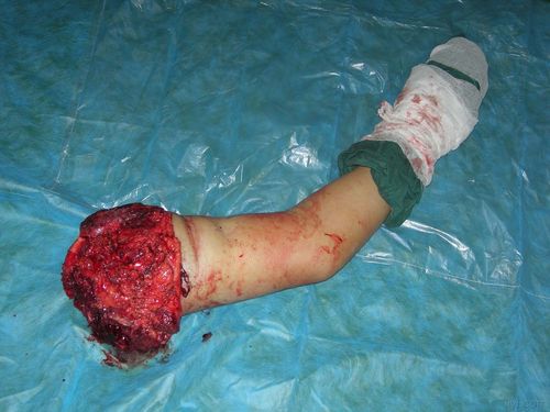 左肱骨骨肉瘤(软骨型)发展太快了