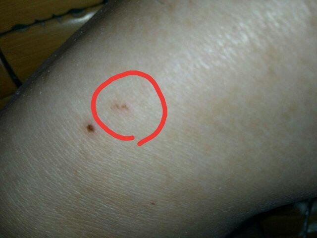 这是狗的牙印吗