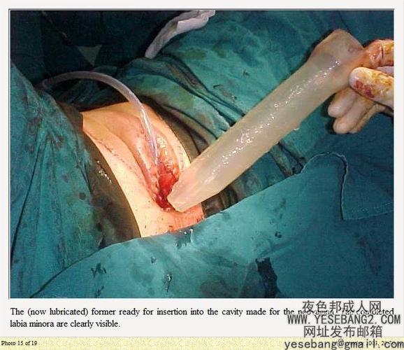 男生变女生的手术详细过程[43p]