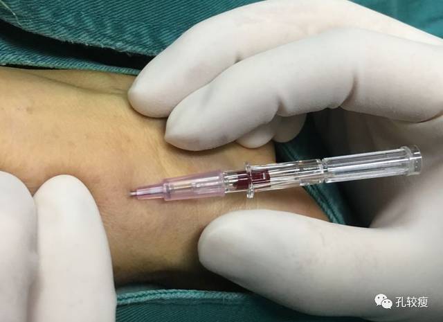 手把手教你桡动脉穿刺置管术