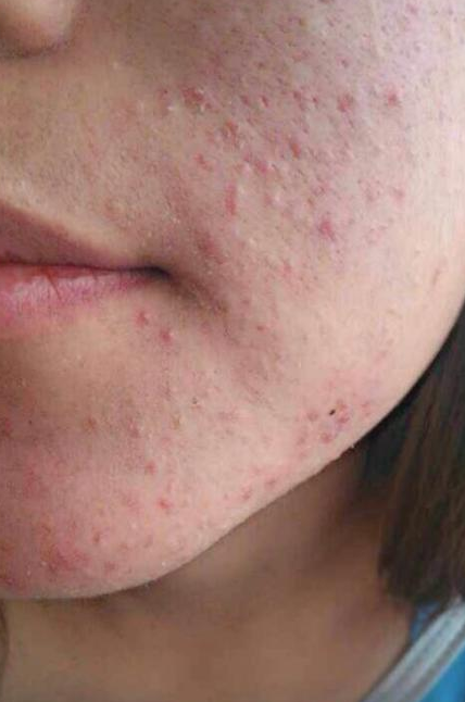 烦人的闭合性粉刺怎么去除才好呢?