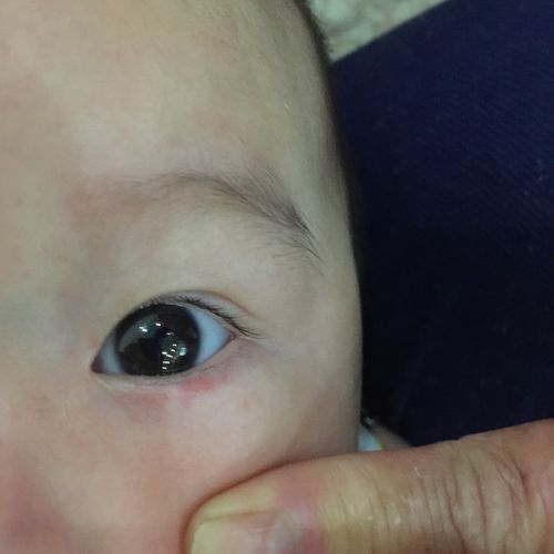 宝宝四个月,下班回家发现宝宝眼皮有块红,请问这是什么?