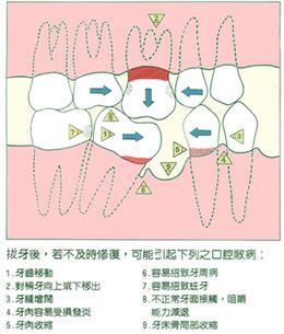 缺牙不镶的危害