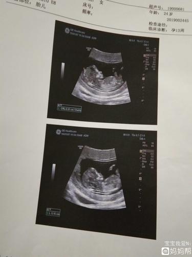12周nt,能看出宝宝性别吗?