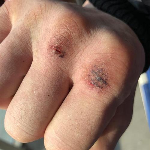 下面是邱建良的拳头近照,从照片中我们可以看出邱建良的拳峰几乎都