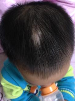 1周岁宝宝头部一块长不出头发