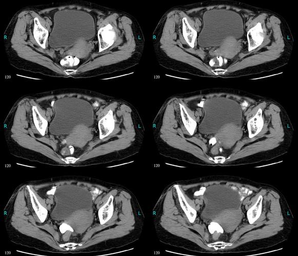 ct48821:膀胱占位