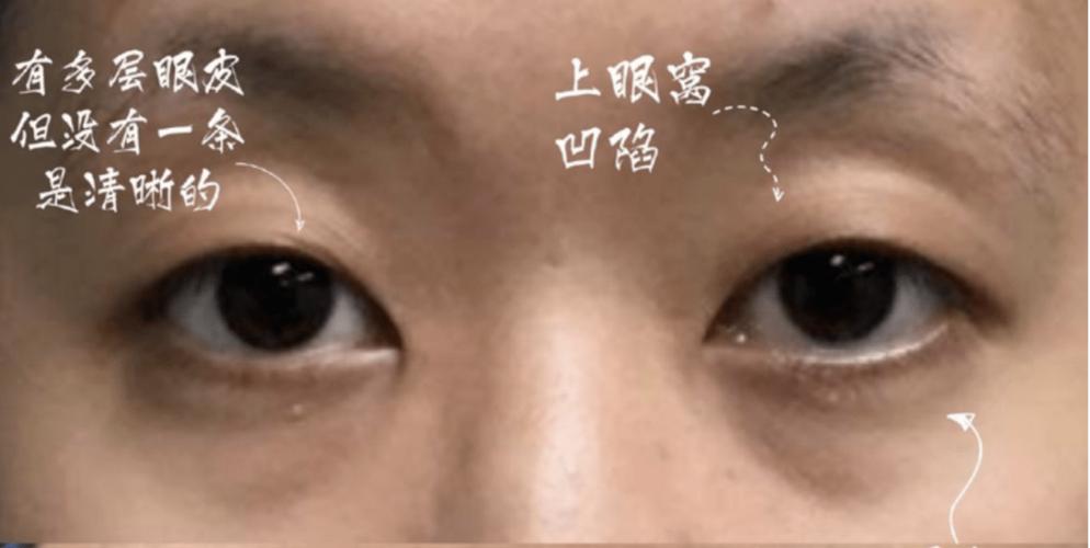 眼窝凹陷的三种解决方案,速速对号入座