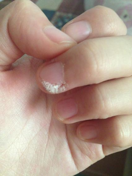 甲周疣甲下疣到底怎么才可以治好呢,以前粗心大意一直没管,现在4,5年