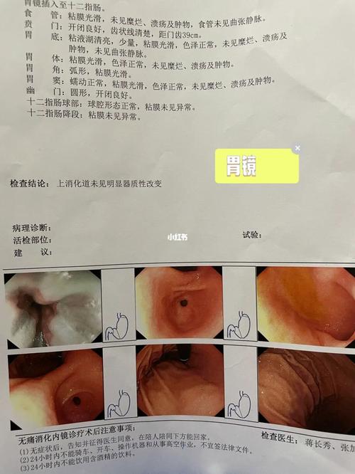 胃镜检查和无痛胃镜检查_肠胃_幽门螺旋杆菌_辣椒_胃痛_胃炎_小米粥