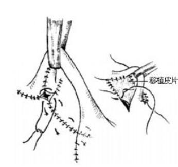 词条:皮瓣移植术; 皮管移植术;; ⑴卷成皮管 ⑵两端褥式缝合或植皮