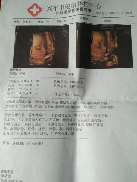 孕24周四维彩超