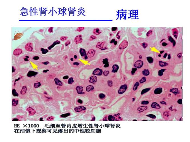 急性肾小球肾炎.