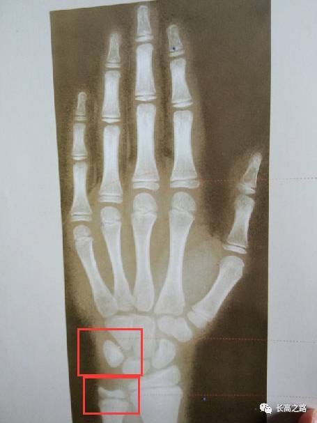 教你简单识别孩子的骨龄片
