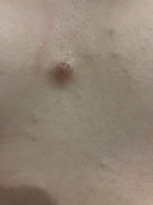 胸口长了一颗东西,不痛不痒的,是怎么回事?