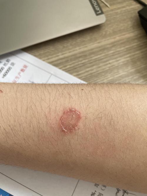 【讨论】人得了猫癣多久才能好啊 我哭了