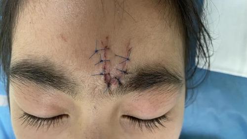 那就是在伤口处理的关键时期进行 精细美容缝合.