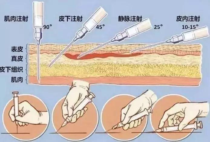 根据药物的作用时间和吸收速度选择肌肉注射或皮下注射,一般皮下注射