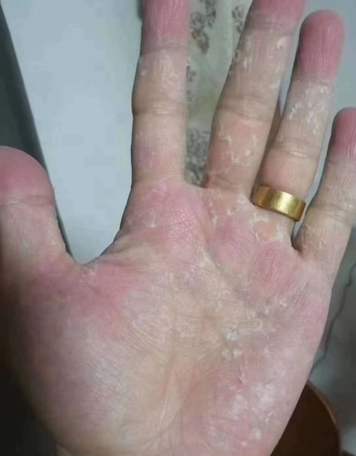 手癣是由于真菌感染导致的,可以分为水疱鳞屑型,浸渍糜烂型以及角化