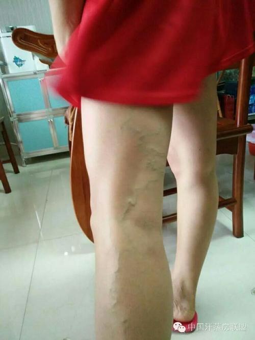 【静脉曲张的克星】汗蒸 吸附矿泥