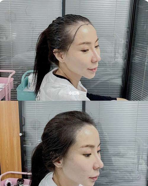 发际线前后对比_发际线_生发_美妆_个人护理