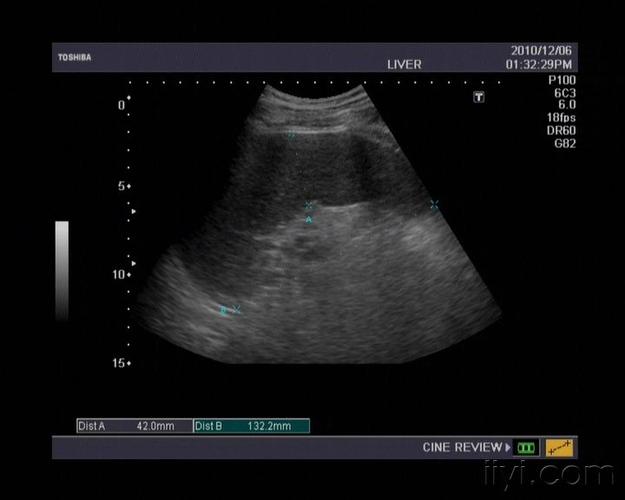 长期透析患者肝大吗,后期脾脏也大吗?