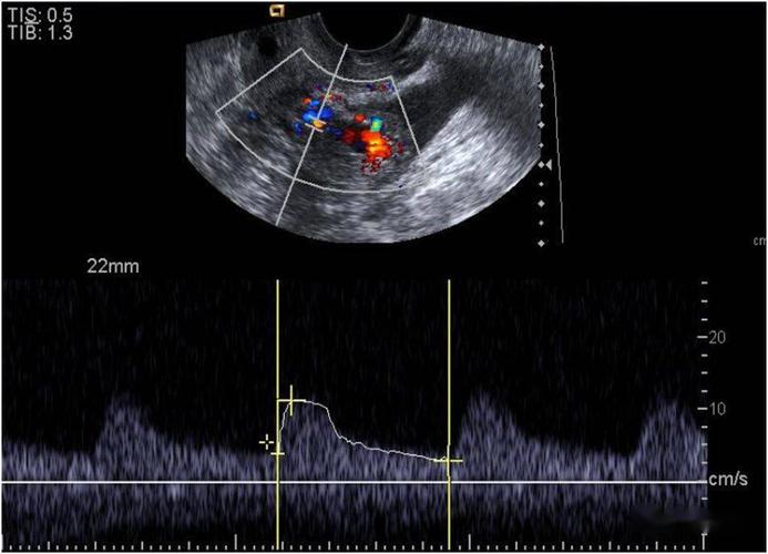 超声典型病例子宫穿孔