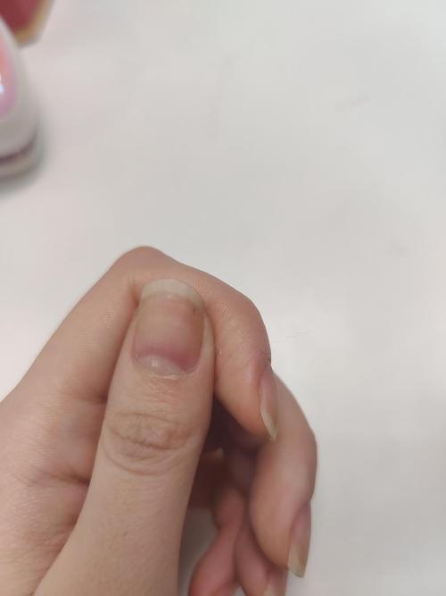 指甲里面有细细的黑线纹路