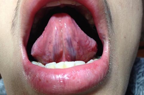 无线新闻 热词 正文  上图舌头下面两条黑线是"舌下静脉怒张",呈现