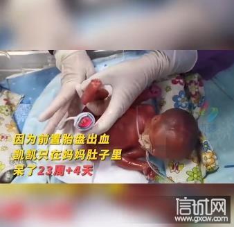 胎龄不满24周超早早产儿出院