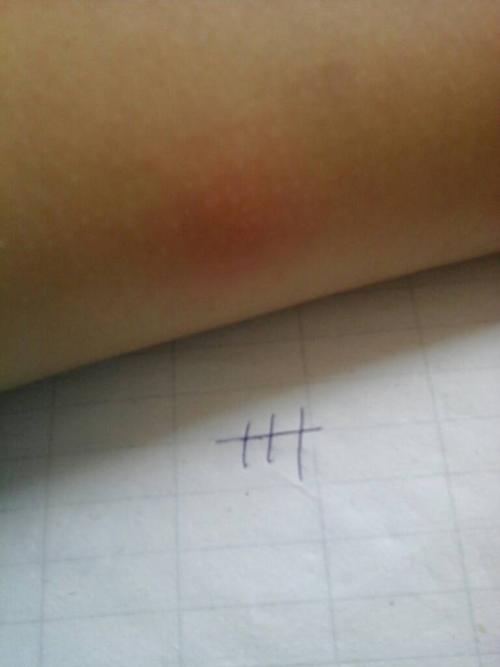 学校做了一个好像叫ppd的皮试,我感觉有点痒,红了一片一恩有点疼,里面